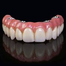 Perfect Smile Restoration