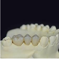 Dental Bridge
